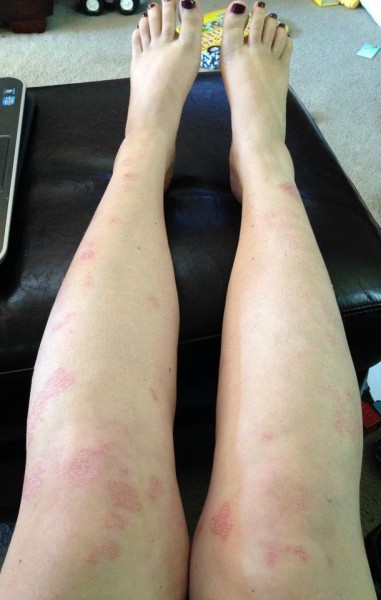 my psoriasis on my legs